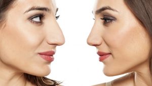 rhinoplastie-chirurgie-correction-nez
